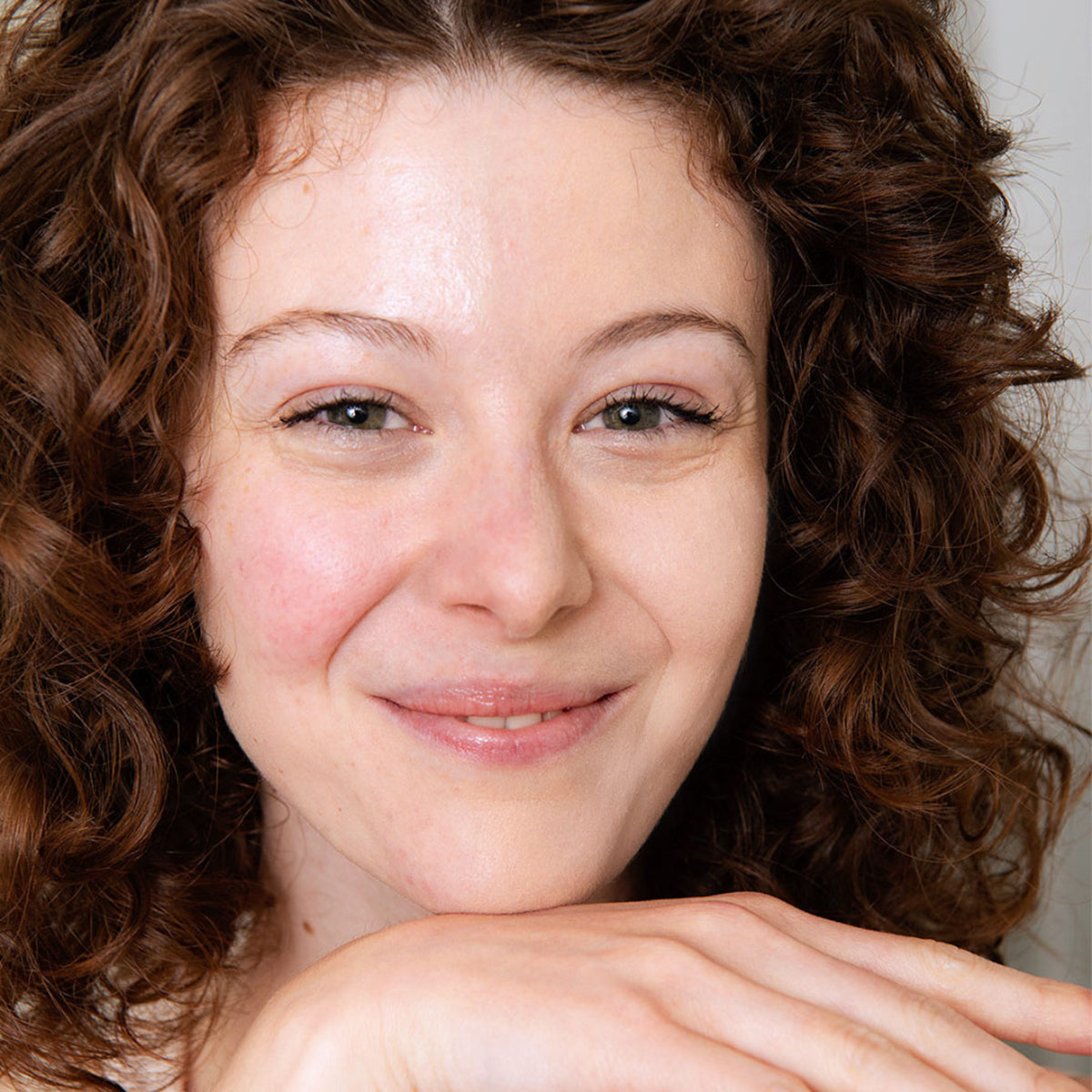 Smiling woman with curly brown hair and visible skin redness, resting her chin on her hand.