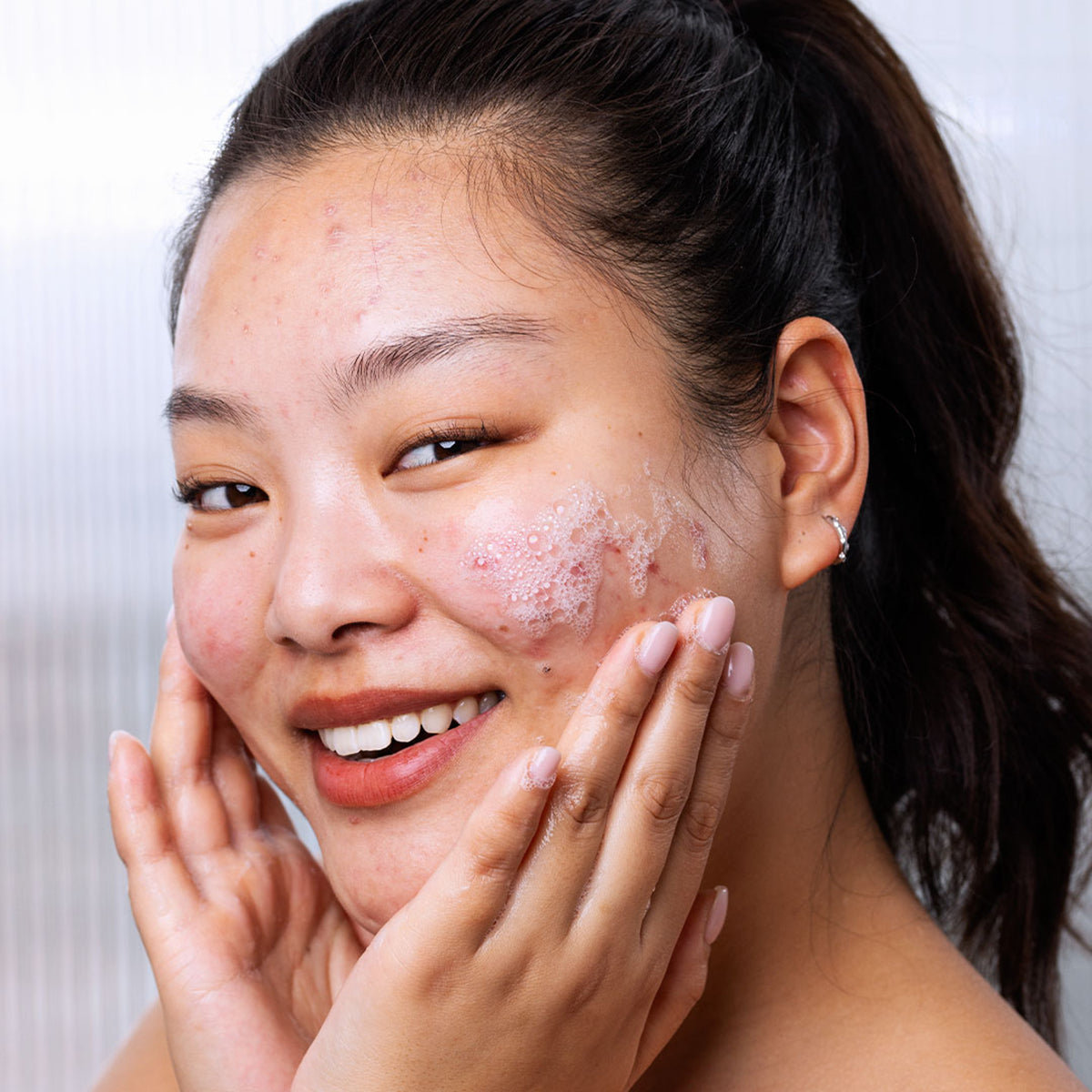 Smiling woman with acne-prone skin applying SEBIACLEAR Gel Moussant, showing a gentle white foaming facial cleanser.